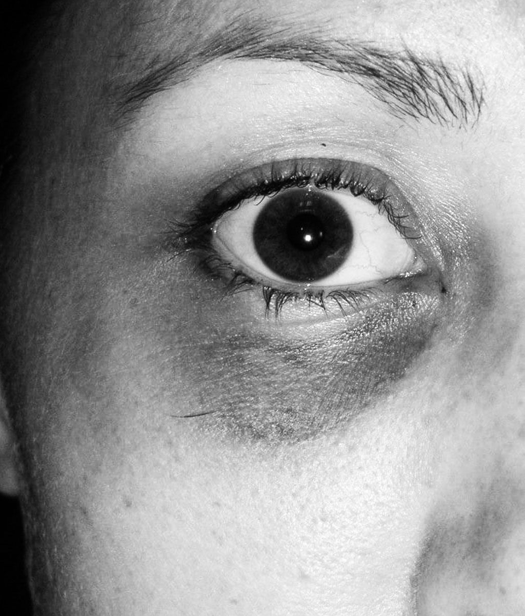 The Hematoma and The Hallway of Cowards